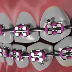 Orthodontist Monrovia | Orthodontics for Kids Monrovia